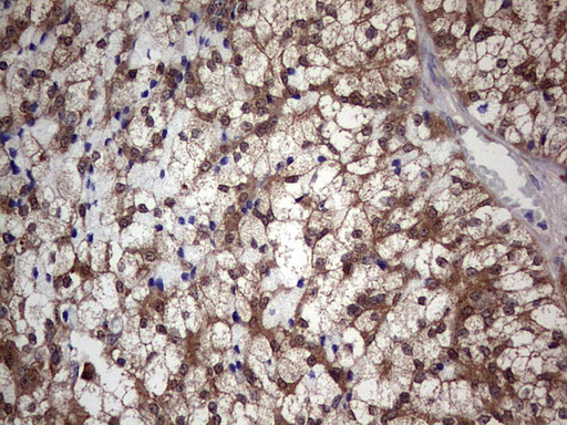 PIK3CA / PI3K Alpha Antibody - IHC of paraffin-embedded Carcinoma of Human pancreas tissue using anti-PIK3CA mouse monoclonal antibody. (Heat-induced epitope retrieval by 1 mM EDTA in 10mM Tris, pH8.5, 120°C for 3min).