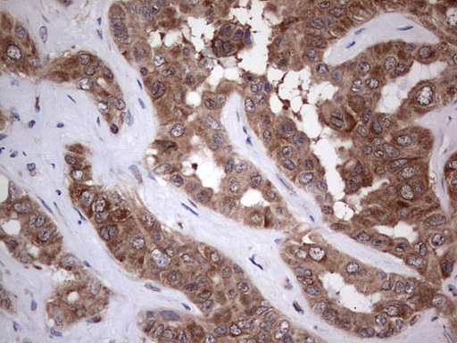 PIK3CA / PI3K Alpha Antibody - IHC of paraffin-embedded Carcinoma of Human liver tissue using anti-PIK3CA mouse monoclonal antibody. (Heat-induced epitope retrieval by 1 mM EDTA in 10mM Tris, pH8.5, 120°C for 3min).