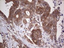 PIK3CA / PI3K Alpha Antibody - IHC of paraffin-embedded Adenocarcinoma of Human colon tissue using anti-PIK3CA mouse monoclonal antibody. (Heat-induced epitope retrieval by 1 mM EDTA in 10mM Tris, pH8.5, 120°C for 3min).