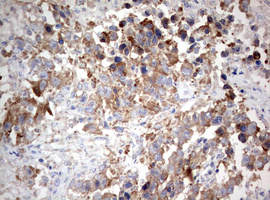 PIK3CA / PI3K Alpha Antibody - IHC of paraffin-embedded Adenocarcinoma of Human ovary tissue using anti-PIK3CA mouse monoclonal antibody. (Heat-induced epitope retrieval by 1 mM EDTA in 10mM Tris, pH8.5, 120°C for 3min).