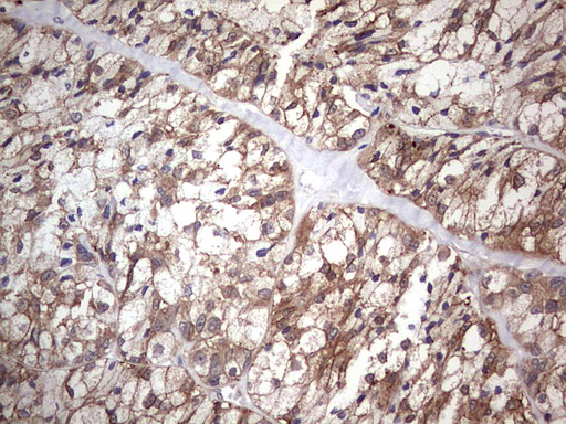 PIK3CA / PI3K Alpha Antibody - IHC of paraffin-embedded Carcinoma of Human thyroid tissue using anti-PIK3CA mouse monoclonal antibody. (Heat-induced epitope retrieval by 1 mM EDTA in 10mM Tris, pH8.5, 120°C for 3min).