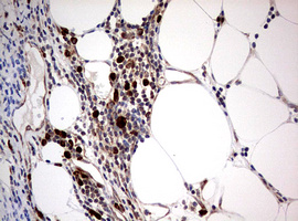 PIK3CA / PI3K Alpha Antibody - IHC of paraffin-embedded Carcinoma of Human bladder tissue using anti-PIK3CA mouse monoclonal antibody. (Heat-induced epitope retrieval by 1 mM EDTA in 10mM Tris, pH8.5, 120°C for 3min).