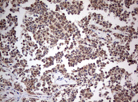 PIK3CA / PI3K Alpha Antibody - IHC of paraffin-embedded Human lymphoma tissue using anti-PIK3CA mouse monoclonal antibody. (Heat-induced epitope retrieval by 1 mM EDTA in 10mM Tris, pH8.5, 120°C for 3min).