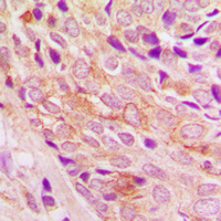 PIK3CA / PI3K Alpha Antibody - Immunohistochemical analysis of PI3K p110 alpha staining in human breast cancer formalin fixed paraffin embedded tissue section. The section was pre-treated using heat mediated antigen retrieval with sodium citrate buffer (pH 6.0). The section was then incubated with the antibody at room temperature and detected using an HRP conjugated compact polymer system. DAB was used as the chromogen. The section was then counterstained with hematoxylin and mounted with DPX.