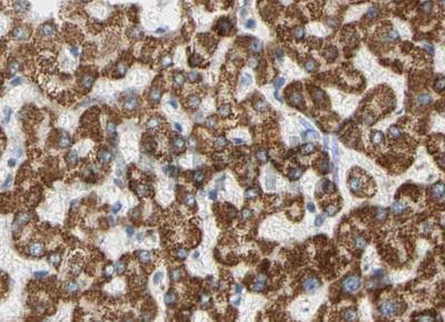 PIK3CA / PI3K Alpha Antibody - 1/100 staining human liver cancer tissue by IHC-P. The sample was formaldehyde fixed and a heat mediated antigen retrieval step in citrate buffer was performed. The sample was then blocked and incubated with the antibody for 1.5 hours at 22°C. An HRP conjugated goat anti-rabbit antibody was used as the secondary antibody.