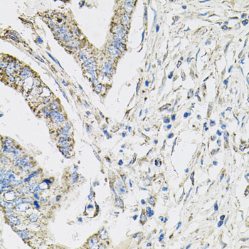 PIK3CB / PI3K Beta Antibody - Immunohistochemistry of paraffin-embedded human colon carcinoma using PIK3CB antibodyat dilution of 1:100 (40x lens).