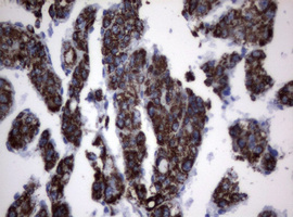 PIK3CD / PI3K Delta Antibody - IHC of paraffin-embedded Carcinoma of Human pancreas tissue using anti-PIK3CD mouse monoclonal antibody. (Heat-induced epitope retrieval by 1 mM EDTA in 10mM Tris, pH8.5, 120°C for 3min).