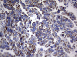 PIK3CD / PI3K Delta Antibody - IHC of paraffin-embedded Carcinoma of Human bladder tissue using anti-PIK3CD mouse monoclonal antibody. (Heat-induced epitope retrieval by 1 mM EDTA in 10mM Tris, pH8.5, 120°C for 3min).