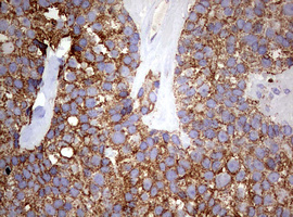 PIK3CD / PI3K Delta Antibody - IHC of paraffin-embedded Adenocarcinoma of Human breast tissue using anti-PIK3CD mouse monoclonal antibody. (Heat-induced epitope retrieval by 1 mM EDTA in 10mM Tris, pH8.5, 120°C for 3min).