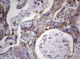 PIK3CD / PI3K Delta Antibody - IHC of paraffin-embedded Adenocarcinoma of Human colon tissue using anti-PIK3CD mouse monoclonal antibody. (Heat-induced epitope retrieval by 1 mM EDTA in 10mM Tris, pH8.5, 120°C for 3min).