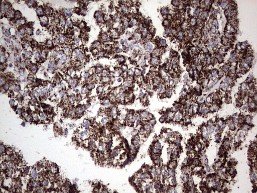 PIK3CD / PI3K Delta Antibody - IHC of paraffin-embedded Carcinoma of Human kidney tissue using anti-PIK3CD mouse monoclonal antibody. (Heat-induced epitope retrieval by 1 mM EDTA in 10mM Tris, pH8.5, 120°C for 3min).