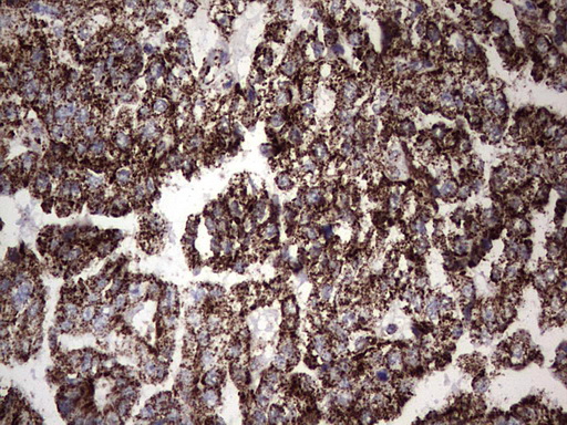 PIK3CD / PI3K Delta Antibody - IHC of paraffin-embedded Adenocarcinoma of Human ovary tissue using anti-PIK3CD mouse monoclonal antibody. (Heat-induced epitope retrieval by 1 mM EDTA in 10mM Tris, pH8.5, 120°C for 3min).