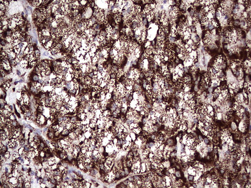 PIK3CD / PI3K Delta Antibody - IHC of paraffin-embedded Carcinoma of Human thyroid tissue using anti-PIK3CD mouse monoclonal antibody. (Heat-induced epitope retrieval by 1 mM EDTA in 10mM Tris, pH8.5, 120°C for 3min).