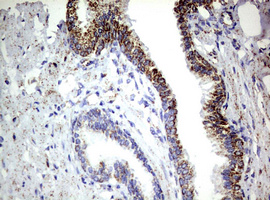 PIK3CD / PI3K Delta Antibody - IHC of paraffin-embedded Carcinoma of Human prostate tissue using anti-PIK3CD mouse monoclonal antibody. (Heat-induced epitope retrieval by 1 mM EDTA in 10mM Tris, pH8.5, 120°C for 3min).