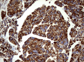 PIK3CD / PI3K Delta Antibody - IHC of paraffin-embedded Carcinoma of Human bladder tissue using anti-PIK3CD mouse monoclonal antibody. (Heat-induced epitope retrieval by 1 mM EDTA in 10mM Tris, pH8.5, 120°C for 3min).