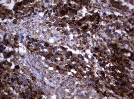 PIK3CD / PI3K Delta Antibody - IHC of paraffin-embedded Adenocarcinoma of Human ovary tissue using anti-PIK3CD mouse monoclonal antibody. (Heat-induced epitope retrieval by 1 mM EDTA in 10mM Tris, pH8.5, 120°C for 3min).