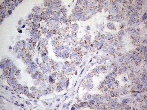 PIK3CD / PI3K Delta Antibody - IHC of paraffin-embedded Carcinoma of Human liver tissue using anti-PIK3CD mouse monoclonal antibody. (Heat-induced epitope retrieval by 1 mM EDTA in 10mM Tris, pH8.5, 120°C for 3min).