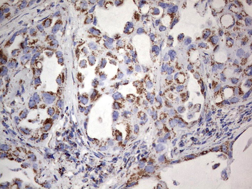 PIK3CD / PI3K Delta Antibody - IHC of paraffin-embedded Carcinoma of Human lung tissue using anti-PIK3CD mouse monoclonal antibody. (Heat-induced epitope retrieval by 1 mM EDTA in 10mM Tris, pH8.5, 120°C for 3min).