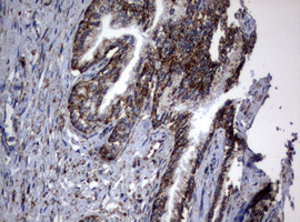 PIK3CD / PI3K Delta Antibody - IHC of paraffin-embedded Carcinoma of Human prostate tissue using anti-PIK3CD mouse monoclonal antibody. (Heat-induced epitope retrieval by 1 mM EDTA in 10mM Tris, pH8.5, 120°C for 3min).