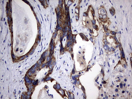 PIK3CD / PI3K Delta Antibody - IHC of paraffin-embedded Adenocarcinoma of Human colon tissue using anti-PIK3CD mouse monoclonal antibody. (Heat-induced epitope retrieval by 1 mM EDTA in 10mM Tris, pH8.5, 120°C for 3min).