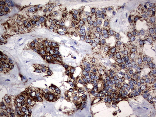 PIK3CD / PI3K Delta Antibody - IHC of paraffin-embedded Carcinoma of Human liver tissue using anti-PIK3CD mouse monoclonal antibody. (Heat-induced epitope retrieval by 1 mM EDTA in 10mM Tris, pH8.5, 120°C for 3min).