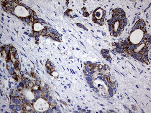 PIK3CD / PI3K Delta Antibody - IHC of paraffin-embedded Carcinoma of Human pancreas tissue using anti-PIK3CD mouse monoclonal antibody. (Heat-induced epitope retrieval by 1 mM EDTA in 10mM Tris, pH8.5, 120°C for 3min).