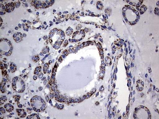 PIK3CD / PI3K Delta Antibody - IHC of paraffin-embedded Carcinoma of Human thyroid tissue using anti-PIK3CD mouse monoclonal antibody. (Heat-induced epitope retrieval by 1 mM EDTA in 10mM Tris, pH8.5, 120°C for 3min).