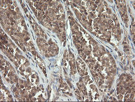 PIK3CG / PI3K Gamma Antibody - IHC of paraffin-embedded Carcinoma of Human thyroid tissue using anti-PIK3CG mouse monoclonal antibody. (Heat-induced epitope retrieval by 10mM citric buffer, pH6.0, 120°C for 3min).