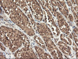 PIK3CG / PI3K Gamma Antibody - IHC of paraffin-embedded Carcinoma of Human thyroid tissue using anti-PIK3CG mouse monoclonal antibody.