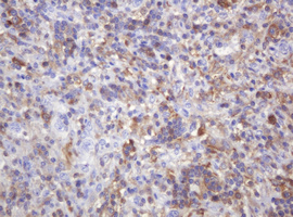PIK3CG / PI3K Gamma Antibody - IHC of paraffin-embedded Human lymphoma tissue using anti-PIK3CG mouse monoclonal antibody.