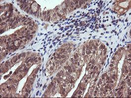PIK3CG / PI3K Gamma Antibody - IHC of paraffin-embedded Adenocarcinoma of Human ovary tissue using anti-PIK3CG mouse monoclonal antibody.