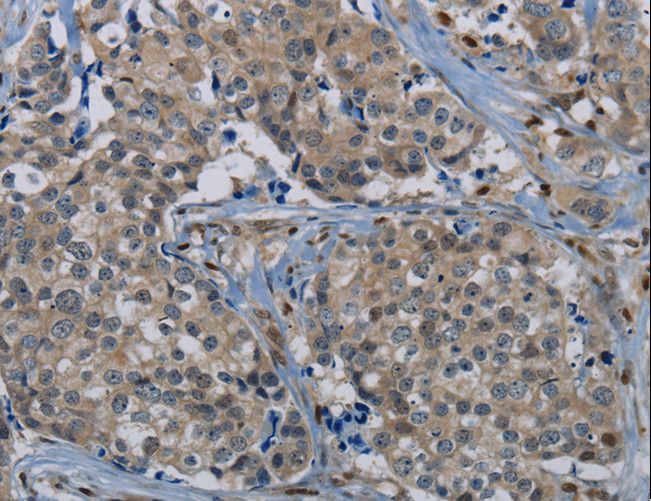 PIK3CG / PI3K Gamma Antibody - Immunohistochemistry of paraffin-embedded Human breast cancer using PIK3CG Polyclonal Antibody at dilution of 1:50.