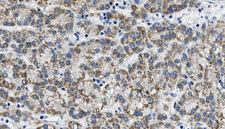 PIK3CG / PI3K Gamma Antibody - 1:100 staining human liver carcinoma tissues by IHC-P. The sample was formaldehyde fixed and a heat mediated antigen retrieval step in citrate buffer was performed. The sample was then blocked and incubated with the antibody for 1.5 hours at 22°C. An HRP conjugated goat anti-rabbit antibody was used as the secondary.