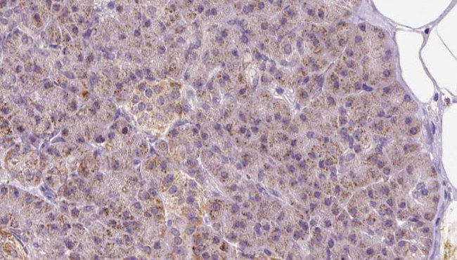 PIK3IP1 / HGFL Antibody - 1:100 staining human pancreas carcinoma tissue by IHC-P. The sample was formaldehyde fixed and a heat mediated antigen retrieval step in citrate buffer was performed. The sample was then blocked and incubated with the antibody for 1.5 hours at 22°C. An HRP conjugated goat anti-rabbit antibody was used as the secondary.