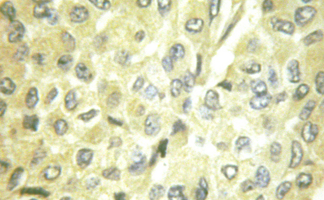 PIK3R1 / p85 Alpha Antibody - 1:100 staining human breast carcinoma tissue by IHC-P. The tissue was formaldehyde fixed and a heat mediated antigen retrieval step in citrate buffer was performed. The tissue was then blocked and incubated with the antibody for 1.5 hours at 22°C. An HRP conjugated goat anti-rabbit antibody was used as the secondary.
