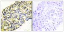 PIK3R1 / p85 Alpha Antibody - Peptide - + Immunohistochemistry analysis of paraffin-embedded human breast carcinoma tissue using PI3-kinase p85-a/? (Ab-467/199) antibody.
