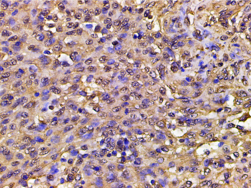 PIK3R1 / p85 Alpha Antibody - 1:200 staining human meningeal carcinomatosis(MC) tissue by IHC-P. The tissue was formaldehyde fixed and a heat mediated antigen retrieval step in citrate buffer was performed. The tissue was then blocked and incubated with the antibody for 1.5 hours at 22°C. An HRP conjugated goat anti-rabbit antibody was used as the secondary.