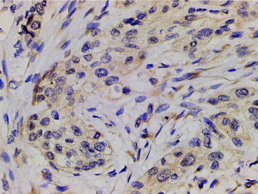 PIK3R1 / p85 Alpha Antibody - 1:200 staining human esophageal carcinoma tissue by IHC-P. The tissue was formaldehyde fixed and a heat mediated antigen retrieval step in citrate buffer was performed. The tissue was then blocked and incubated with the antibody for 1.5 hours at 22°C. An HRP conjugated goat anti-rabbit antibody was used as the secondary.