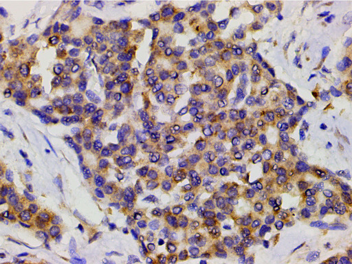 PIK3R1 / p85 Alpha Antibody - 1:200 staining human liver carcinoma tissues by IHC-P. The tissue was formaldehyde fixed and a heat mediated antigen retrieval step in citrate buffer was performed. The tissue was then blocked and incubated with the antibody for 1.5 hours at 22°C. An HRP conjugated goat anti-rabbit antibody was used as the secondary.
