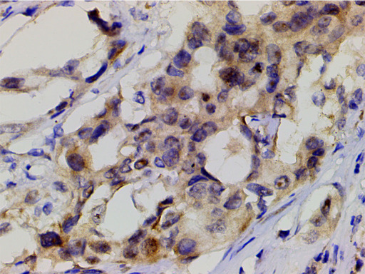 PIK3R1 / p85 Alpha Antibody - 1:200 staining human lung carcinoma tissue by IHC-P. The tissue was formaldehyde fixed and a heat mediated antigen retrieval step in citrate buffer was performed. The tissue was then blocked and incubated with the antibody for 1.5 hours at 22°C. An HRP conjugated goat anti-rabbit antibody was used as the secondary.