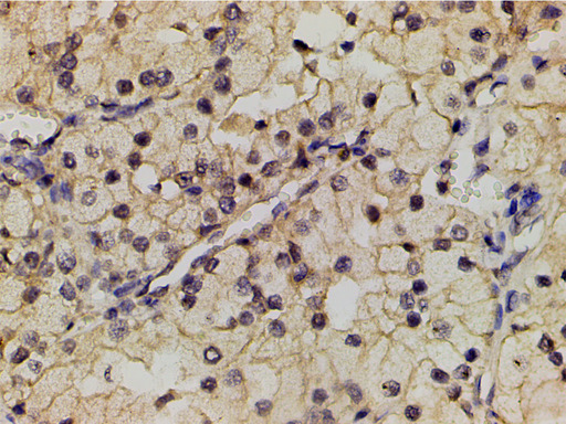 PIK3R1 / p85 Alpha Antibody - 1:200 staining human renal clear cells carcinoma tissue by IHC-P. The tissue was formaldehyde fixed and a heat mediated antigen retrieval step in citrate buffer was performed. The tissue was then blocked and incubated with the antibody for 1.5 hours at 22°C. An HRP conjugated goat anti-rabbit antibody was used as the secondary.