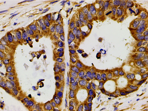 PIK3R1 / p85 Alpha Antibody - 1:200 staining human colon carcinoma tissue by IHC-P. The tissue was formaldehyde fixed and a heat mediated antigen retrieval step in citrate buffer was performed. The tissue was then blocked and incubated with the antibody for 1.5 hours at 22°C. An HRP conjugated goat anti-rabbit antibody was used as the secondary.
