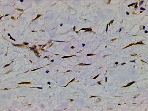 PIK3R1 / p85 Alpha Antibody - 1:200 staining human bladder carcinoma tissue by IHC-P. The tissue was formaldehyde fixed and a heat mediated antigen retrieval step in citrate buffer was performed. The tissue was then blocked and incubated with the antibody for 1.5 hours at 22°C. An HRP conjugated goat anti-rabbit antibody was used as the secondary.