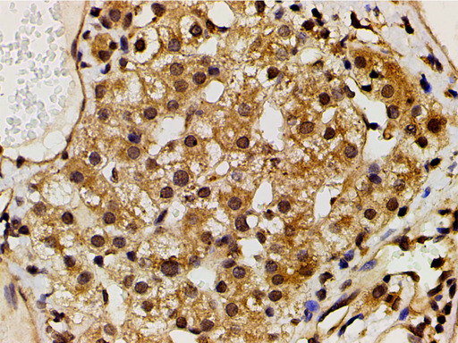 PIK3R1 / p85 Alpha Antibody - 1:200 staining human vascular carcinoma tissue by IHC-P. The tissue was formaldehyde fixed and a heat mediated antigen retrieval step in citrate buffer was performed. The tissue was then blocked and incubated with the antibody for 1.5 hours at 22°C. An HRP conjugated goat anti-rabbit antibody was used as the secondary.