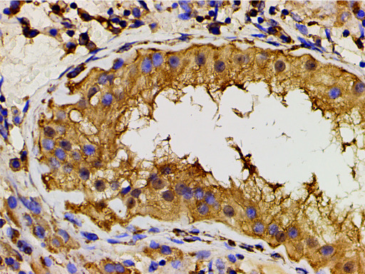 PIK3R1 / p85 Alpha Antibody - 1:200 staining human seminoma tissue by IHC-P. The tissue was formaldehyde fixed and a heat mediated antigen retrieval step in citrate buffer was performed. The tissue was then blocked and incubated with the antibody for 1.5 hours at 22°C. An HRP conjugated goat anti-rabbit antibody was used as the secondary.