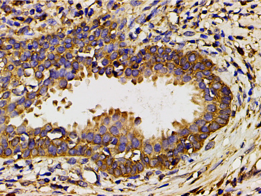 PIK3R1 / p85 Alpha Antibody - 1:200 staining human myosarcoma tissue by IHC-P. The tissue was formaldehyde fixed and a heat mediated antigen retrieval step in citrate buffer was performed. The tissue was then blocked and incubated with the antibody for 1.5 hours at 22°C. An HRP conjugated goat anti-rabbit antibody was used as the secondary.