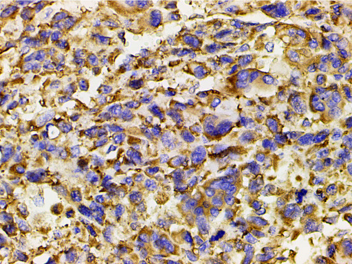 PIK3R1 / p85 Alpha Antibody - 1:200 staining human osteosarcoma tissue by IHC-P. The tissue was formaldehyde fixed and a heat mediated antigen retrieval step in citrate buffer was performed. The tissue was then blocked and incubated with the antibody for 1.5 hours at 22°C. An HRP conjugated goat anti-rabbit antibody was used as the secondary.