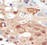 PIK3R2 / p85 Beta Antibody - Formalin-fixed and paraffin-embedded human cancer tissue reacted with the primary antibody, which was peroxidase-conjugated to the secondary antibody, followed by AEC staining. This data demonstrates the use of this antibody for immunohistochemistry; clinical relevance has not been evaluated. BC = breast carcinoma; HC = hepatocarcinoma.