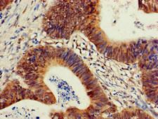 PIK3R2 / p85 Beta Antibody - Immunohistochemistry of paraffin-embedded human colon cancer at dilution of 1:100