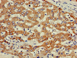 PIK3R2 / p85 Beta Antibody - Immunohistochemistry of paraffin-embedded human liver cancer at dilution of 1:100